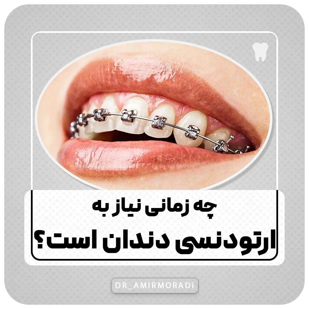 چه زمانی نیاز به ارتودنسی است