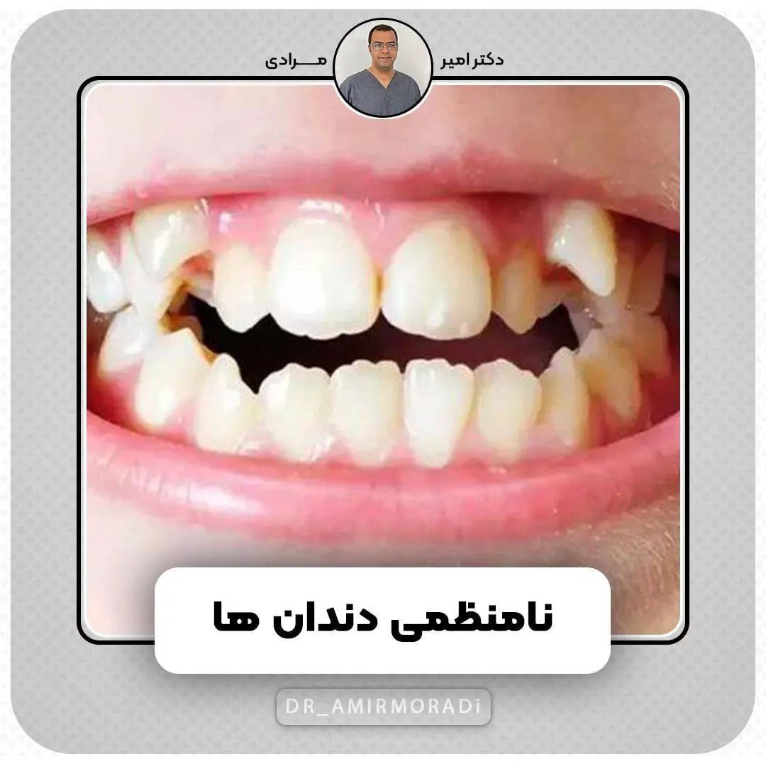 چه زمانی نیاز به ارتودنسی است