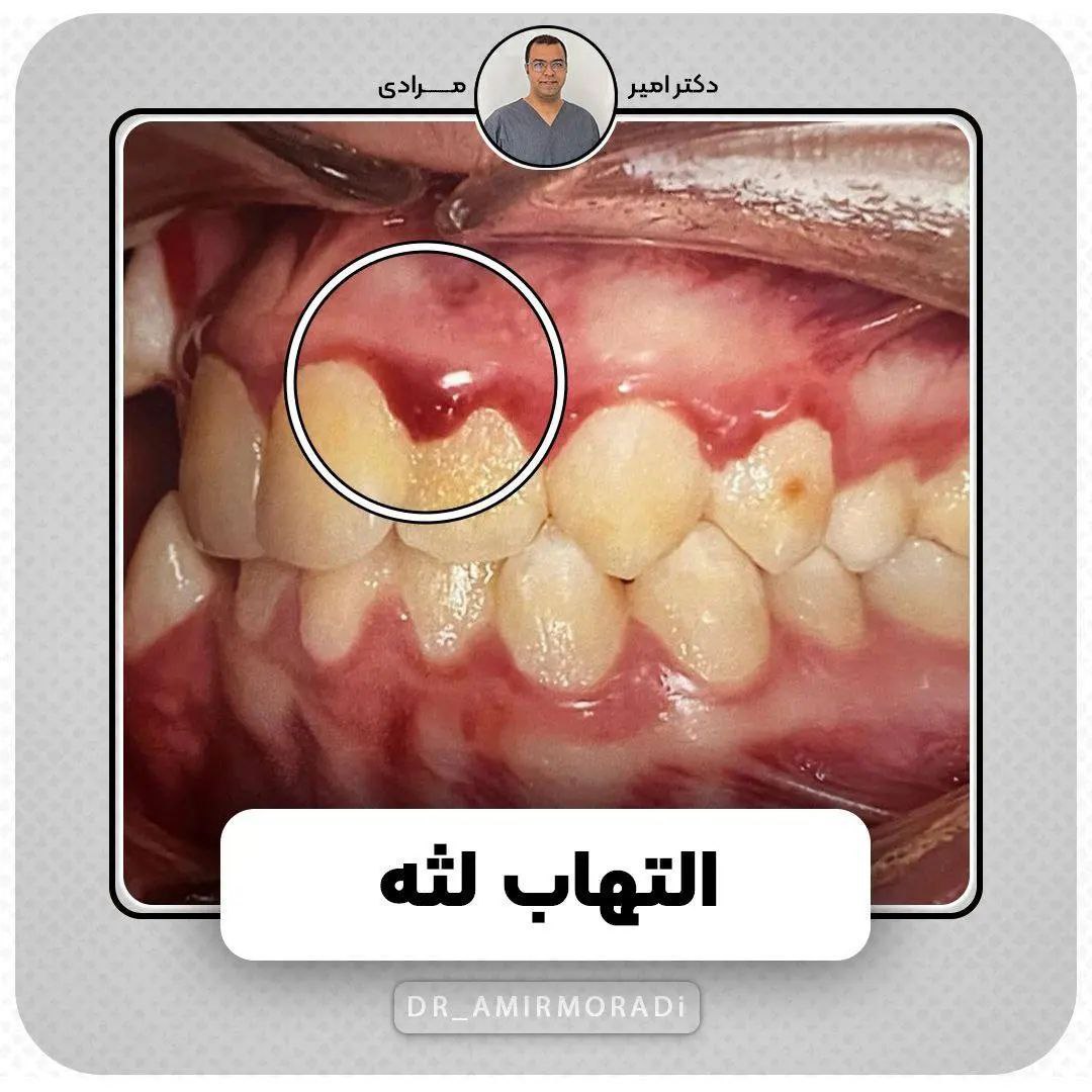 چه زمانی نیاز به ارتودنسی است