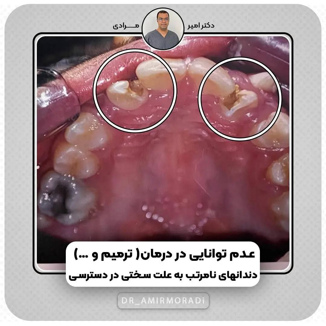 چه زمانی نیاز به ارتودنسی است