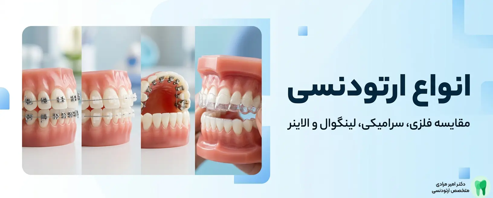 انواع ارتودنسی؛ مقایسه فلزی، سرامیکی، لینگوال و الاینر